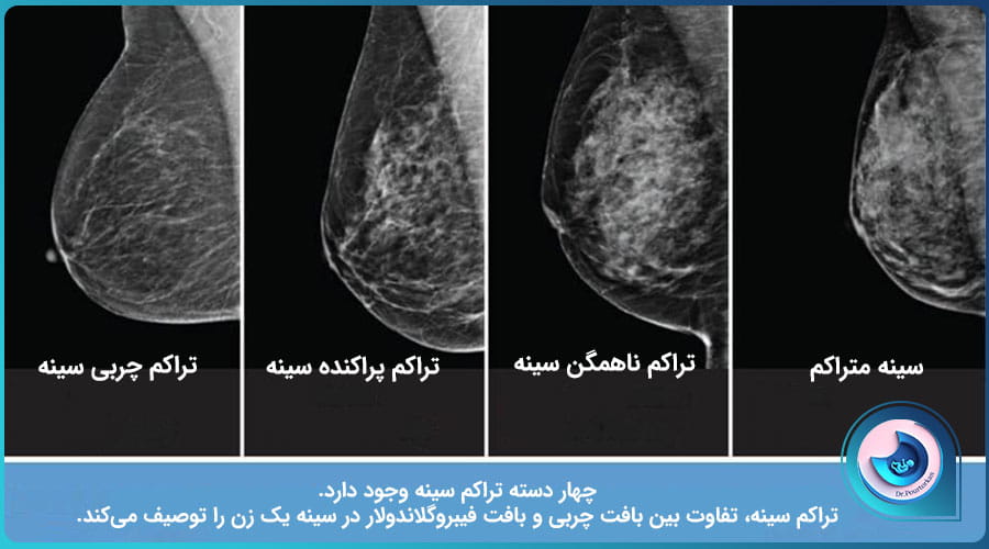 چه زمانی باید زودتر ماموگرافی انجام داد