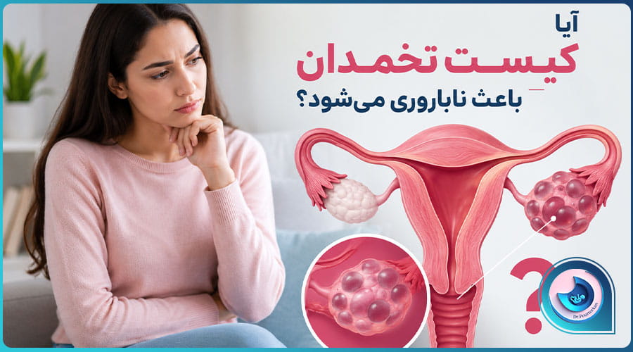 کیست تخمدان و ناباروری