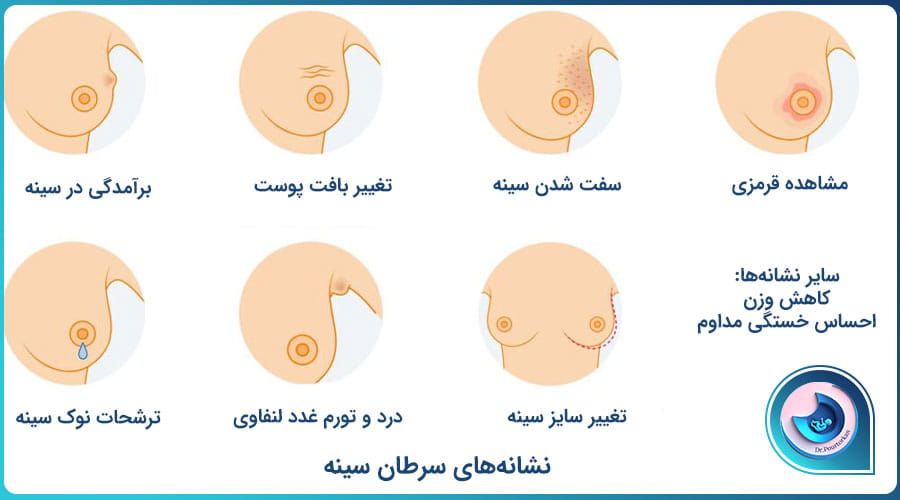 نشانههای سرطان سینه