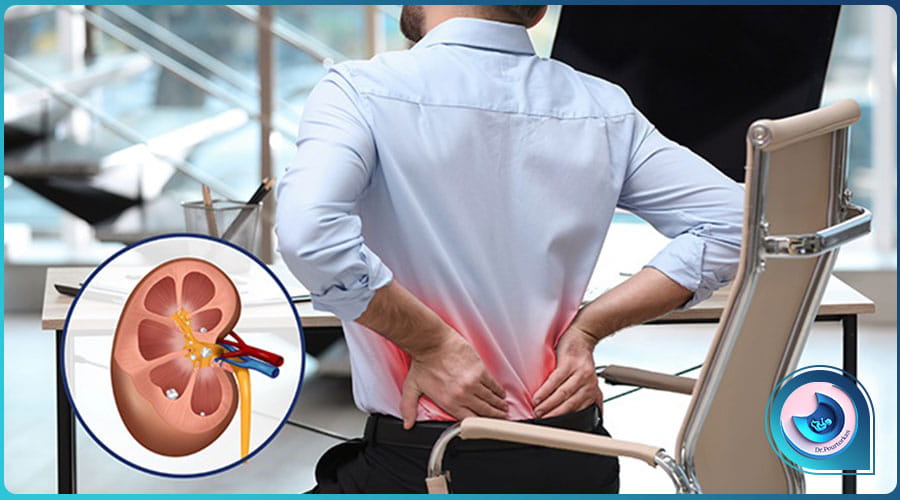 تشخیص سنگ کلیه